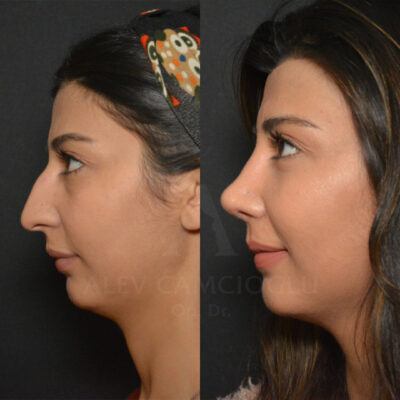 Bahar Igde Natural Looking Rhinoplasty