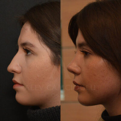 Ceren Aliakar Natural Looking Rhinoplasty