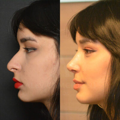 Ecem Tahiroglu Natural Looking Rhinoplasty