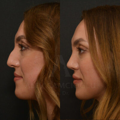 Gizem Kuru Natural Looking Rhinoplasty