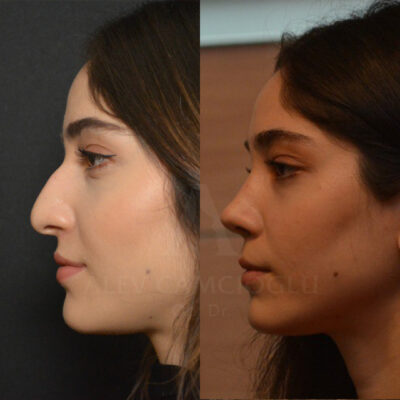 Gulistan Yildiz Natural Looking Rhinoplasty