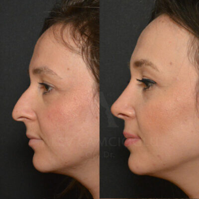 Kubra Kamisoglu Natural Looking Rhinoplasty