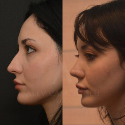 Nergiz Duz Natural Looking Rhinoplasty