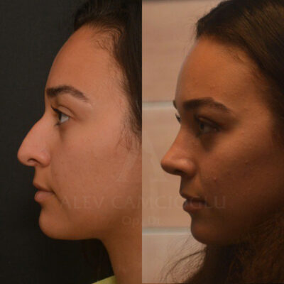 Nursena Durmus Natural Looking Rhinoplasty