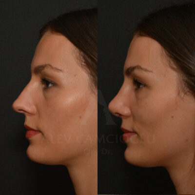 Ozge Yavuz Natural Looking Rhinoplasty