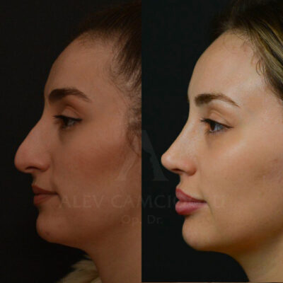 Seda Atalay Natural Looking Rhinoplasty