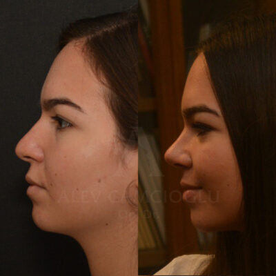 Tuana Karaoglu Natural Looking Rhinoplasty