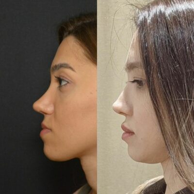 5 Years After Revision Rhinoplasty with Rib Cartilage