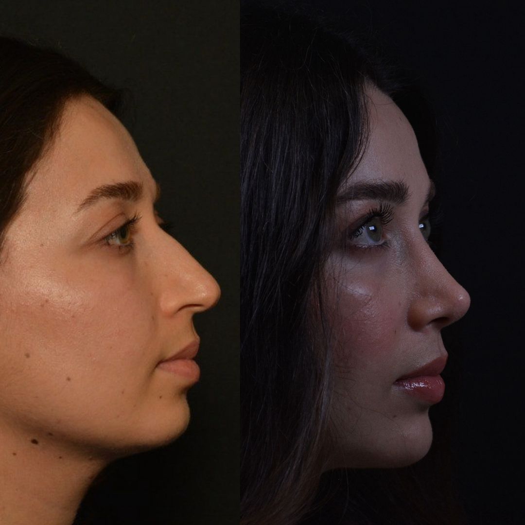 9 months after rhinoplasty result