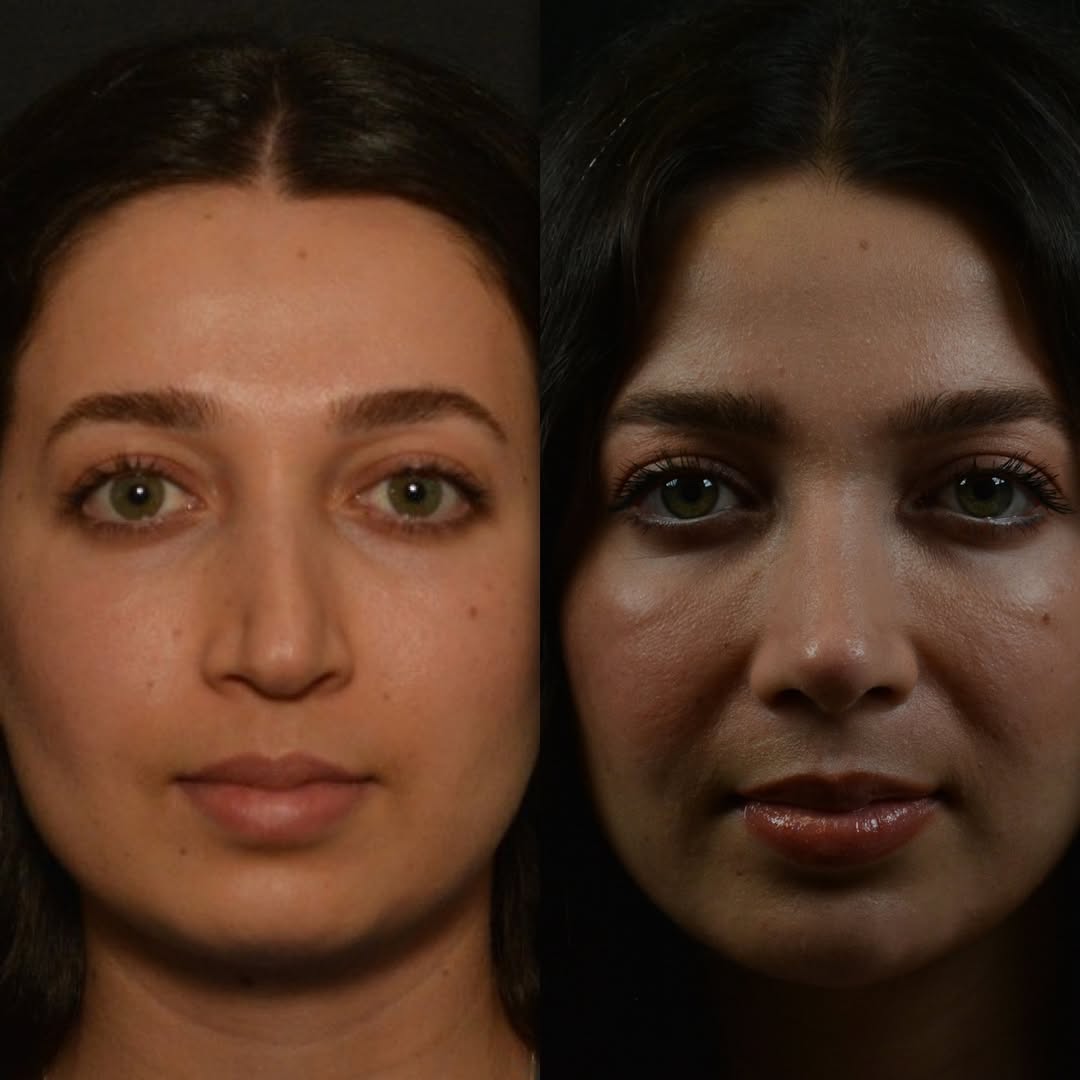 9 months after rhinoplasty result