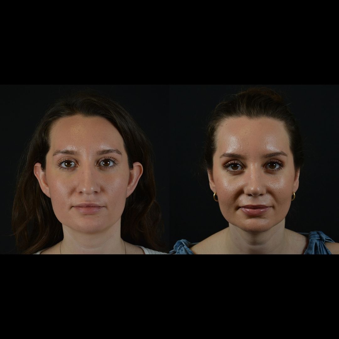 Otoplasty and Rhinoplasty Combined Before and After