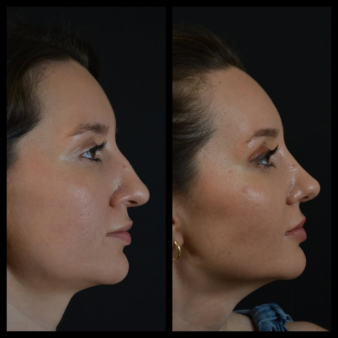 Otoplasty and Rhinoplasty Combined Before and After Side View