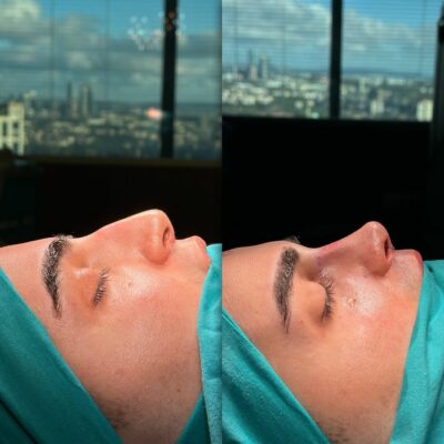 Rhinoplasty for a nose with high radix, big hump, severe deviation and crookness before after