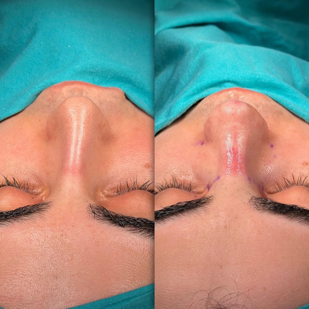 Rhinoplasty for a nose with high radix, big hump, severe deviation and crookness before after upper view