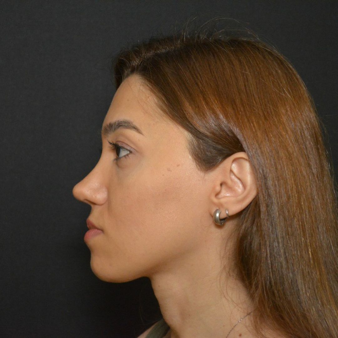 before Revision Rhinoplasty with Rib Cartilage