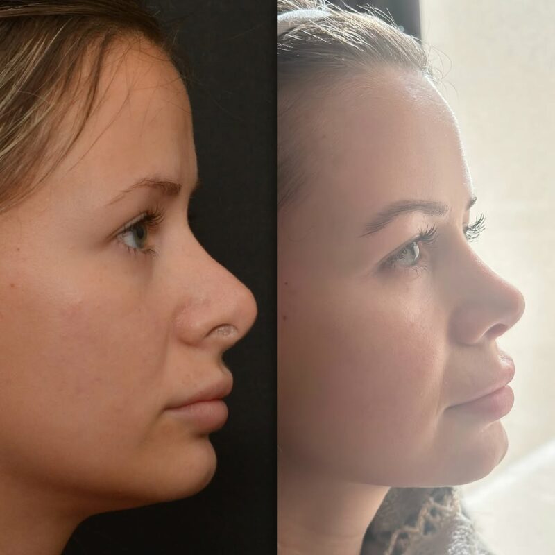 female revision rhinoplasty before and after