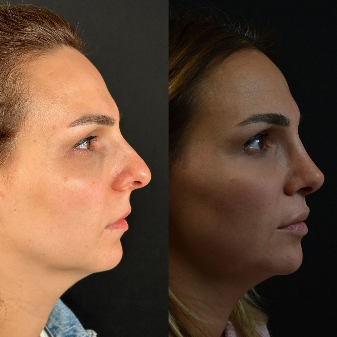 Rhinoplasty and lip lift together before after